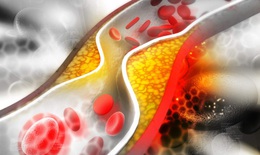 Thuốc hạ lipid máu có thể giúp cắt giảm thời gian điều trị bệnh nhân COVID-19 nặng