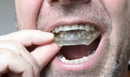 Nghiến răng, bệnh lý cần điều trị để tránh hậu quả đáng tiếc