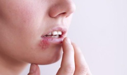 Bệnh mụn rộp sinh dục dễ nhầm với mụn nhọt thông thường