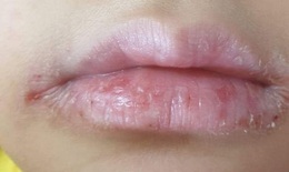 Thuốc nào điều trị viêm da môi bong vảy?