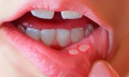  Loét miệng và cách điều trị hiệu quả