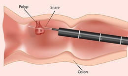 Ph&#225;t hiện sớm ung thư đại tr&#224;ng tăng cơ hội điều trị th&#224;nh c&#244;ng