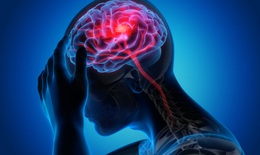Nhận biết và đề phòng đau đầu migraine tái phát