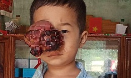 Xót xa em bé dân tộc bị khối u đẩy lồi mắt ra ngoài, nguy cơ nhiễm trùng cao