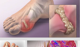 Bệnh gút và những điều bạn cần biết