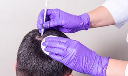 Thẩm mỹ viện du ký: Những điều bạn cần biết trước khi cấy tóc thẩm mỹ