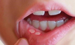 5 nguyên nhân gây loét miệng ở người nhiễm HIV