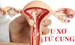 U xơ tử cung: Nguyên nhân, dấu hiệu nhận biết và cách điều trị