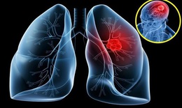 Ung thư phổi: C&#225;c phương ph&#225;p chẩn đo&#225;n 