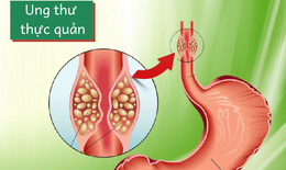 Các biểu hiện của ung thư thực quản