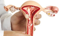 Polyp nội mạc tử cung: Nguyên nhân, nhận biết và các phương pháp điều trị