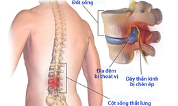 B&#224;i tập ph&#242;ng ngừa v&#224; phục hồi hội chứng đau thắt lưng