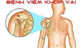 5 bài tập phục hồi viêm quanh khớp vai