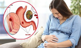 Đau dạ dày khi mang thai, nguyên nhân và cách xử trí 