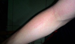 Nhiễm ký sinh trùng từ thói quen nhặt rau hàng ngày