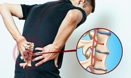 Dùng thuốc chữa đau lưng do viêm cột sống dính khớp ở người trẻ