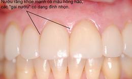 Ngăn ngừa vi&#234;m nướu răng bằng chế độ dinh dưỡng hiệu quả