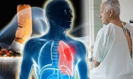 Làm sao để phát hiện sớm bệnh ung thư phổi?