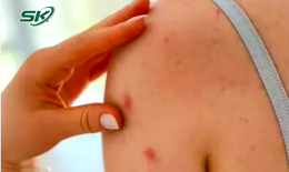 Sức khỏe của bệnh nhân thứ 2 mắc đậu mùa khỉ ở Việt Nam ra sao?