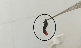 Quảng Ninh: Chảy máu cam, đi khám phát hiện con vắt dài 2cm trong mũi