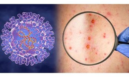 Việt Nam đã triển khai những giải pháp gì ứng phó với dịch bệnh đậu mùa khỉ?