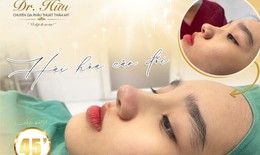 Nâng mũi đẹp tự nhiên bởi bác sĩ thẩm mỹ Lê Mai Hữu