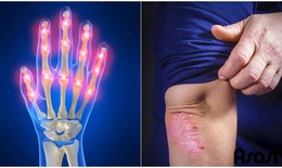 Ai dễ bị viêm khớp vẩy nến?