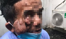 Cắt bỏ khối u đeo đẳng suốt 30 năm trên mặt người đàn ông