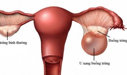 Chuyên gia cảnh báo phụ nữ mang thai không nên chủ quan với u buồng trứng