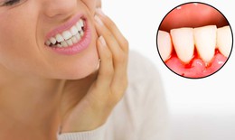 6 bài thuốc làm nước súc miệng chống chảy máu chân răng