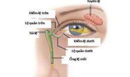 Tắc ống lệ mũi ở trẻ sơ sinh, cách nhận biết và điều trị