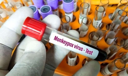 Ca nghi mắc đậu mùa khỉ ở Đắk Lắk có kết quả xét nghiệm âm tính