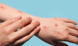 Đậu mùa khỉ có thể lây truyền trước khi các triệu chứng xuất hiện