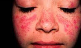 D&#249;ng đơn thuốc cũ chữa lupus ban đỏ, nữ bệnh nh&#226;n phải nhập viện cấp cứu