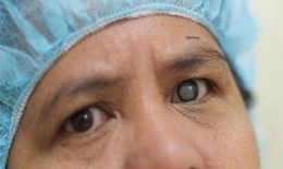 Phòng tránh đục thủy tinh thể xuất hiện sớm ở người cận thị cao