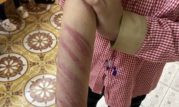 Hải Phòng: Cô giáo phát hiện trên người học sinh nhiều vết thương chằng chịt, nghi bị bạo hành