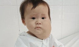 Xót xa bé gái dân tộc H’Mông 1 tuổi có khuôn mặt biến dạng vì khối u lớn