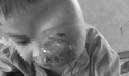 Xót xa hình ảnh cậu bé 6 tuổi biến dạng khuôn mặt, một bên mắt đã mù vĩnh viễn vì khối u lớn