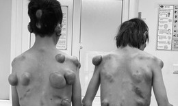 Căn bệnh khiến 2 anh em sinh đôi mọc hàng trăm khối u trên cơ thể như "người củi"