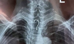 Gắp lưỡi câu mắc trong thực quản cụ già 83 tuổi