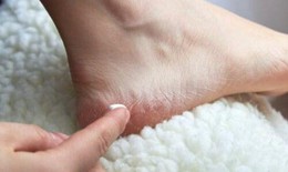 Cách chăm sóc gót chân khô, nứt nẻ trong mùa lạnh