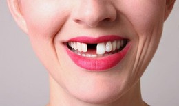 Nguyên nhân và các hệ lụy của tình trạng mất răng