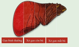 Triển vọng điều trị xơ gan cổ trướng bằng tế bào gốc tự thân