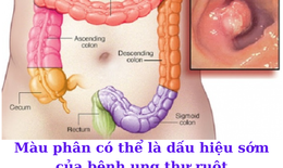 Thay đổi th&#243;i quen đi đại tiện c&#243; thể l&#224; dấu hiệu cảnh b&#225;o bệnh ung thư ruột