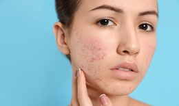 Thuốc kháng sinh trị mụn trứng cá có thể ảnh hưởng đến xương ở thanh thiếu niên