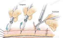 Cấy tóc tự thân: giải đáp các câu hỏi thường gặp từ chuyên gia