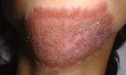 Lao da là bệnh gì, điều trị thế nào?