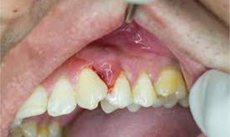 Thuốc trị ợ chua có thể cải thiện bệnh nướu răng