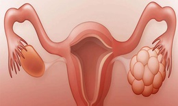 Các biện pháp kiểm soát sinh sản tốt nhất cho phụ nữ bị buồng trứng đa nang