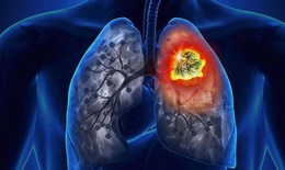 Điều trị viêm phổi tại nhà và những lưu ý giúp sớm phục hồi sức khỏe
